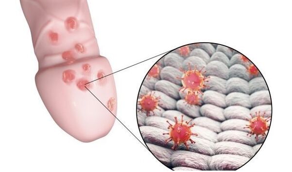 alergia na żel powiększający penisa
